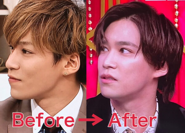 千賀健永が鼻先にヒアルロン酸を入れる前と後の比較画像
